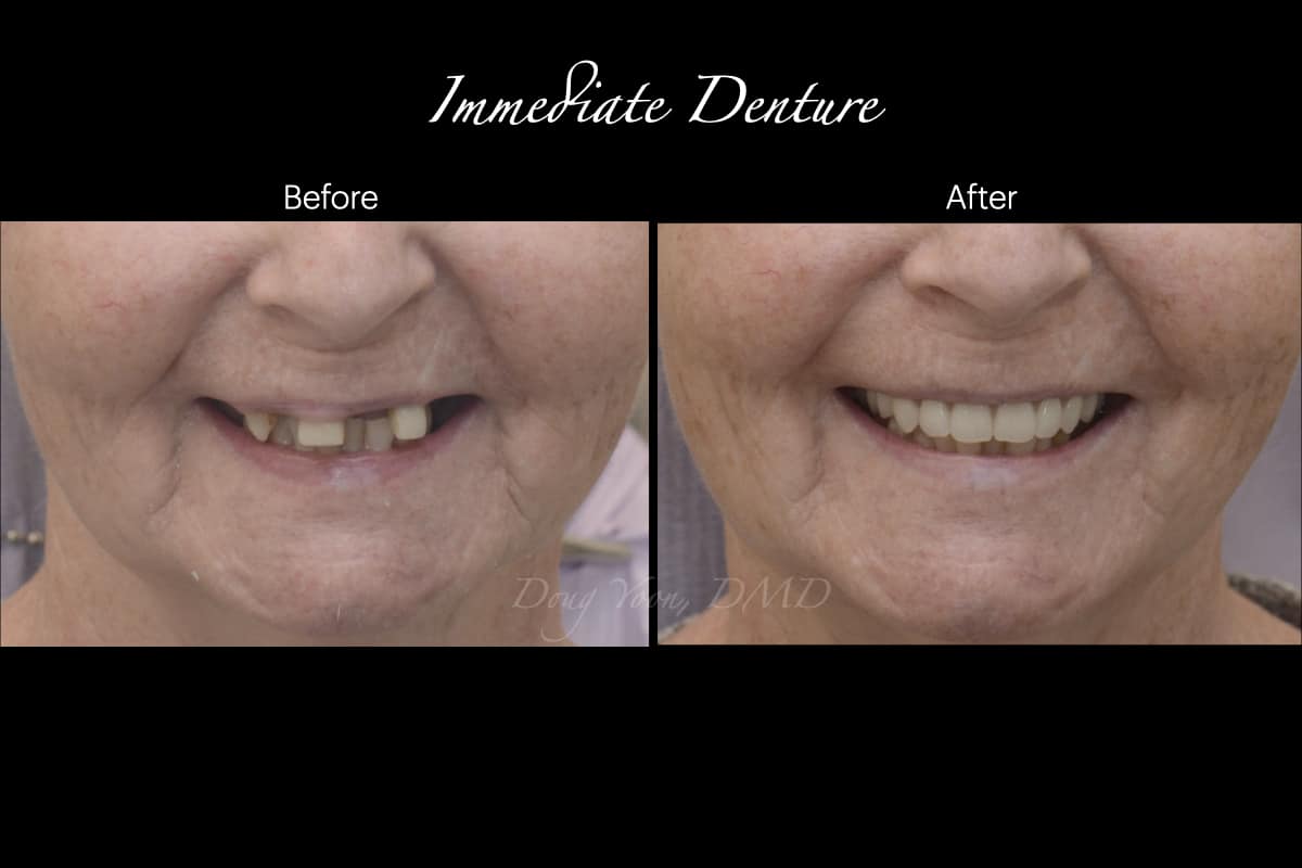 Immediate Denture