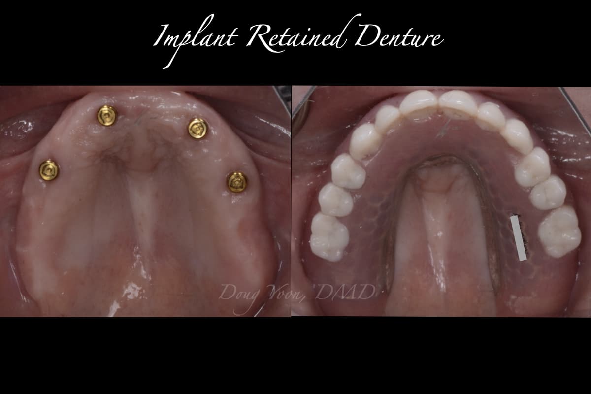 Implant Dentures