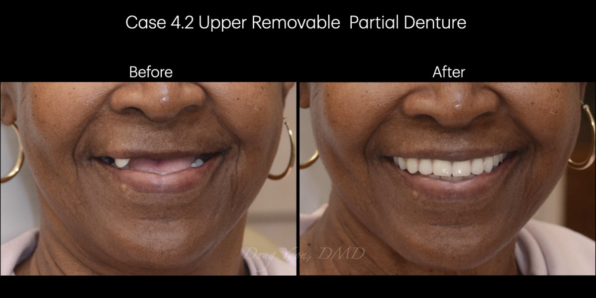 Moonglow Website Before After Smile Gallery.007