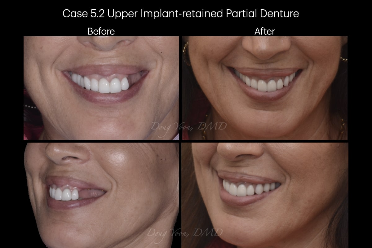 Moonglow Website Before After Smile Gallery.009