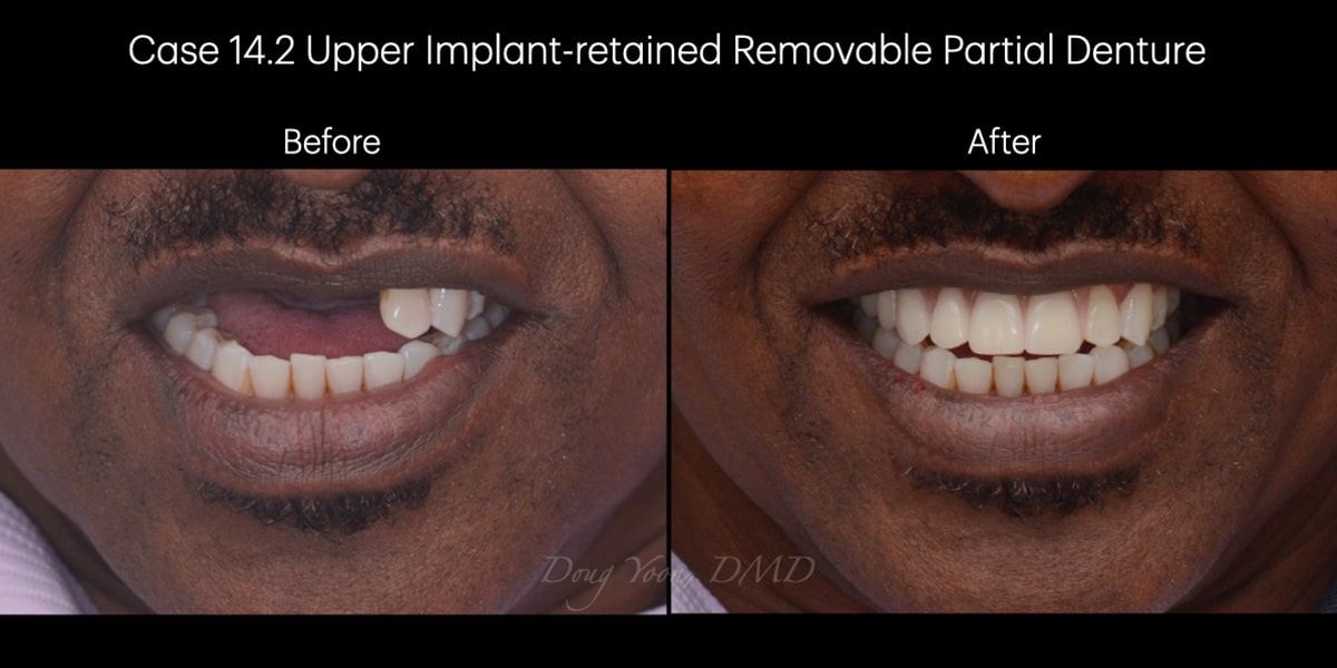 Moonglow Website Before After Smile Gallery.023