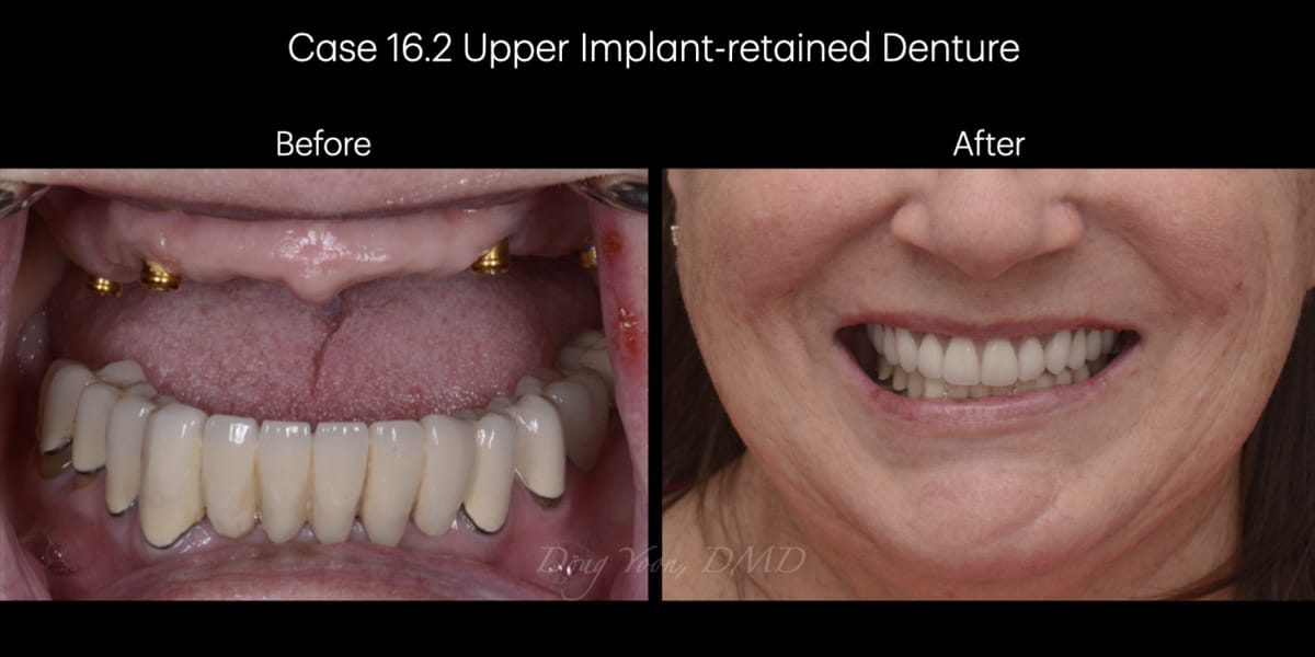 Moonglow Website Before After Smile Gallery.027