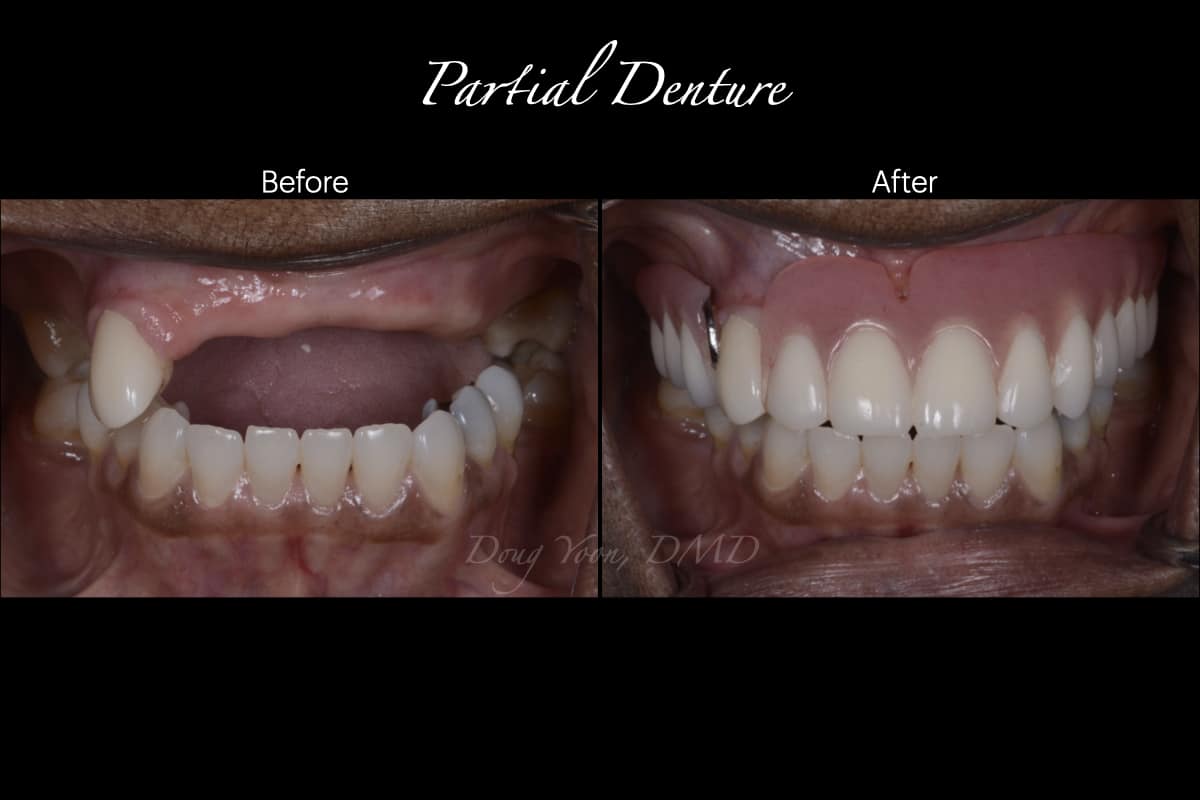 Partial Dentures
