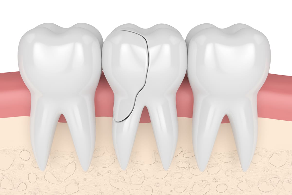 Can Cracked or Broken Dentures Be Fixed, or Do They Need Replacement?